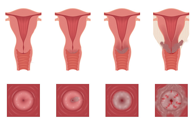 Cancer col utérus